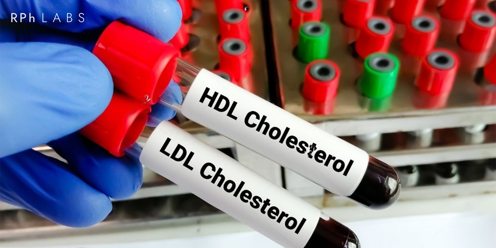 Genetic Testing for Cholesterol Drugs