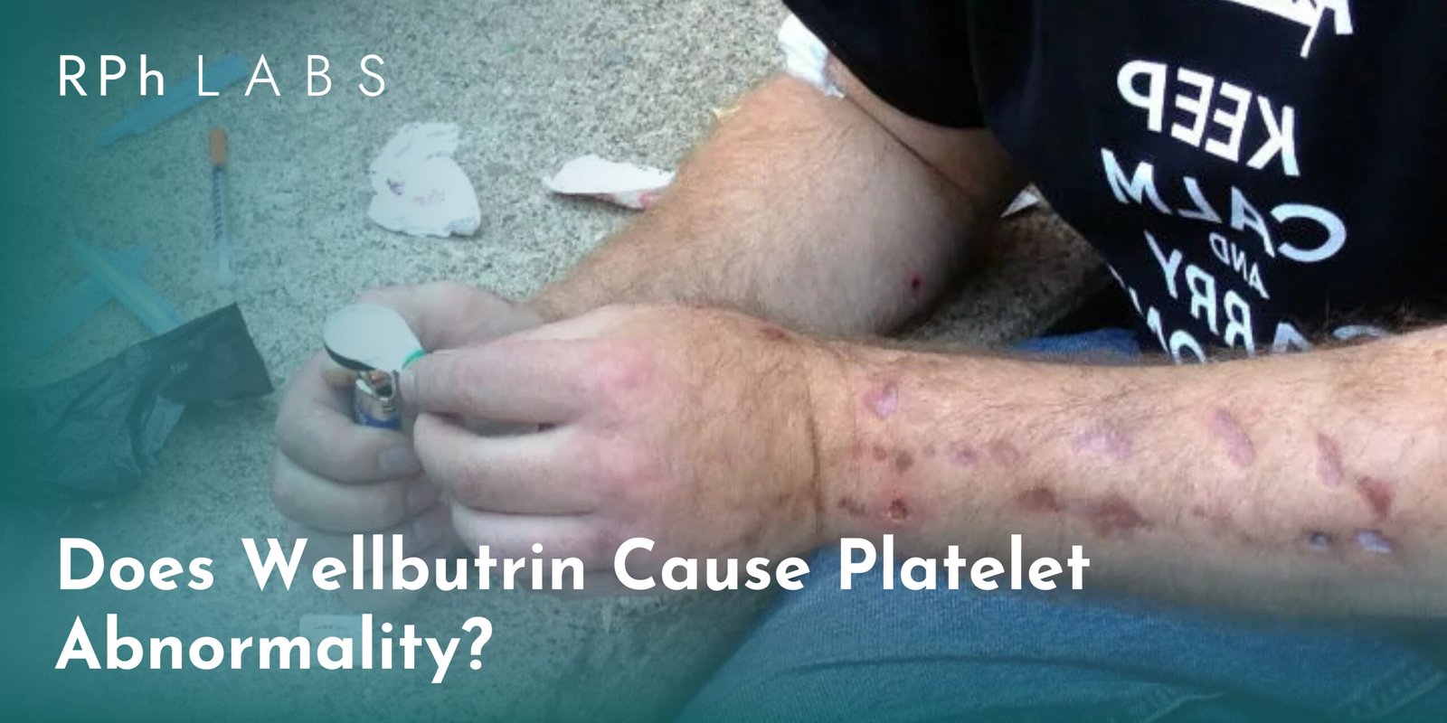 Does Wellbutrin Cause Platelet Abnormality