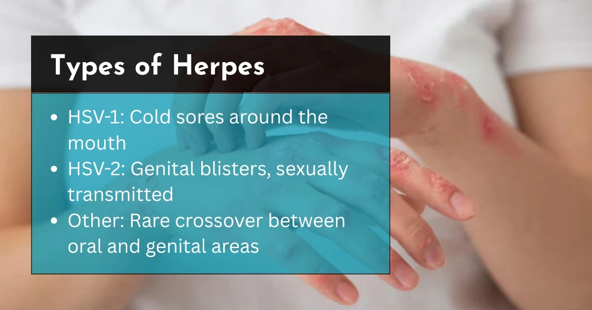 Types of Herpes