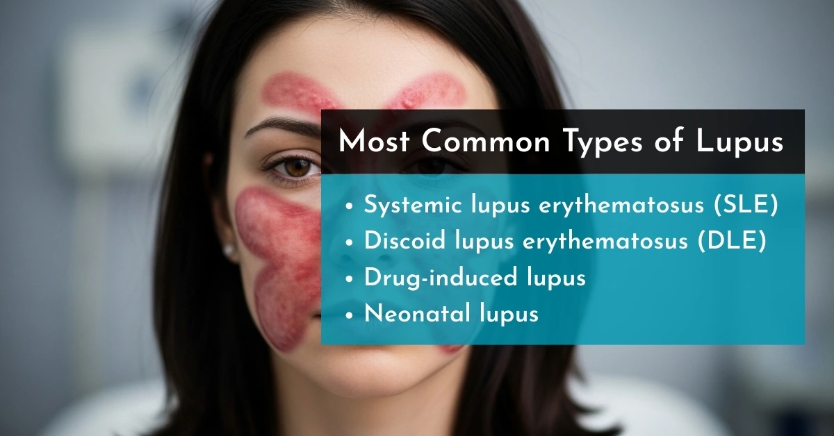 Most Common Types of Lupus