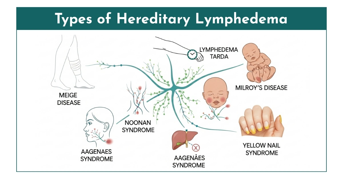 Types of Hereditary Lymphedema
